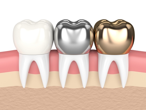 Types Of Dental Crowns